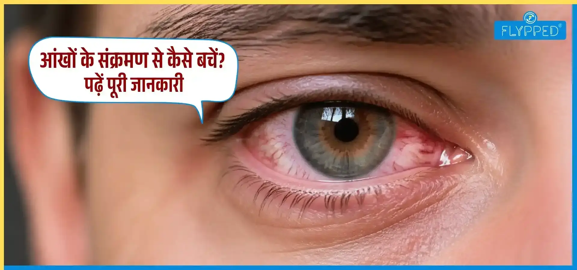 Eye Flu in Hindi: आंखों के संक्रमण से कैसे बचें? पढ़ें पूरी जानकारी