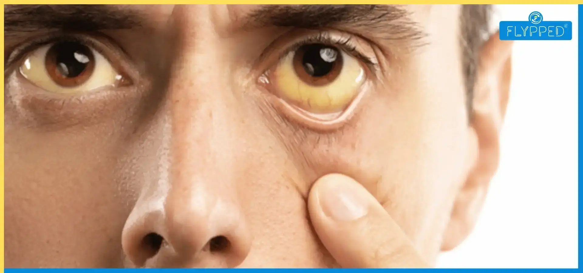 Jaundice Meaning in Hindi (पीलिया क्या होता है)