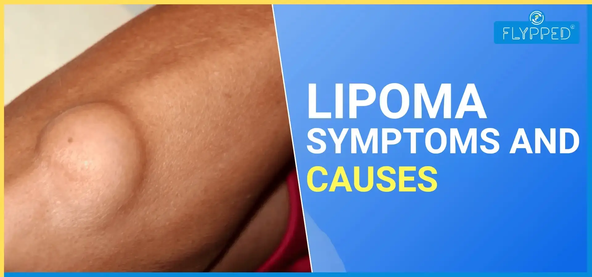 Lipoma in Hindi: Symptoms, Causes, Types and Treatment
